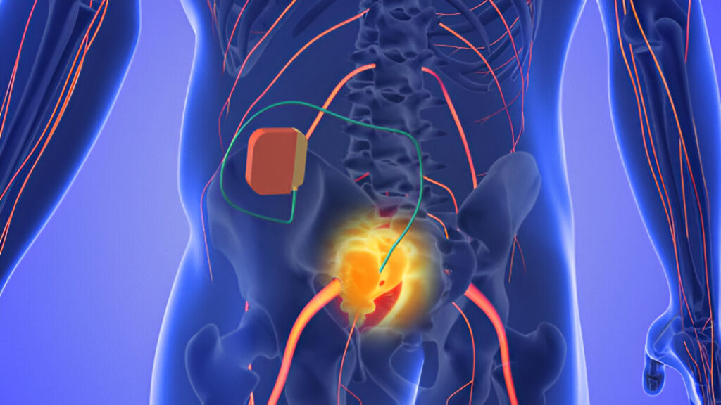 Living with Neurogenic Bowel and Bladder Dysfunction After a Spinal Cord Injury